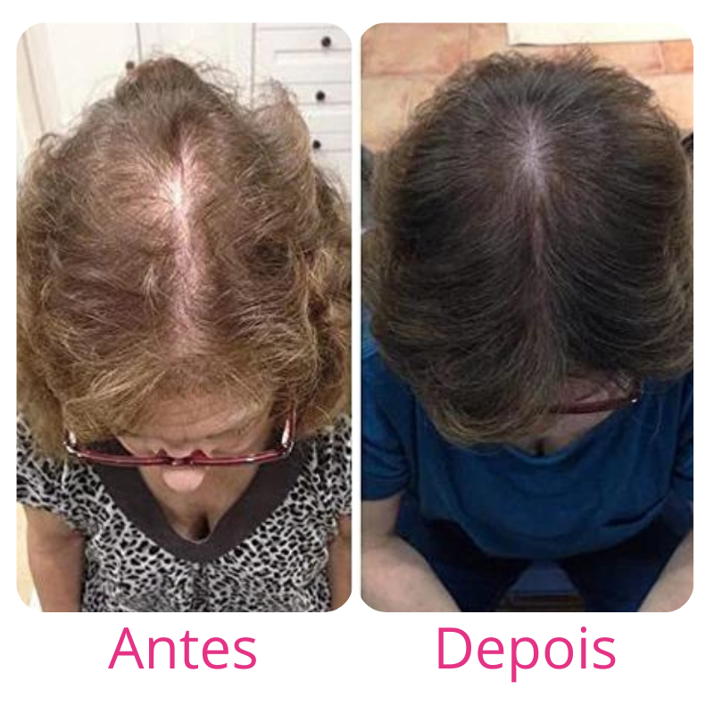 Harmony Hair Tratamento de 1 mês