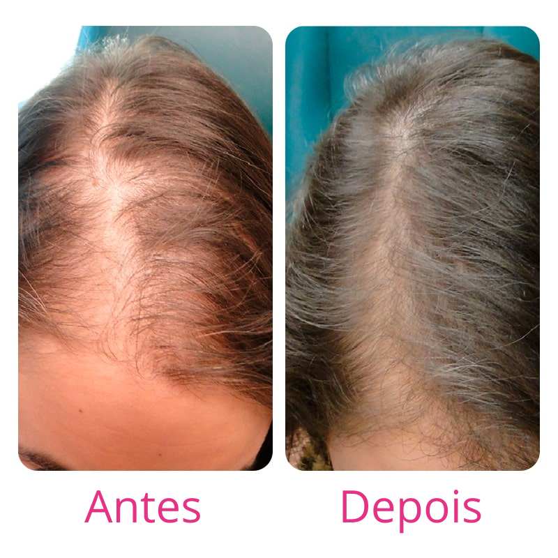 Harmony Hair Tratamento de 1 mês