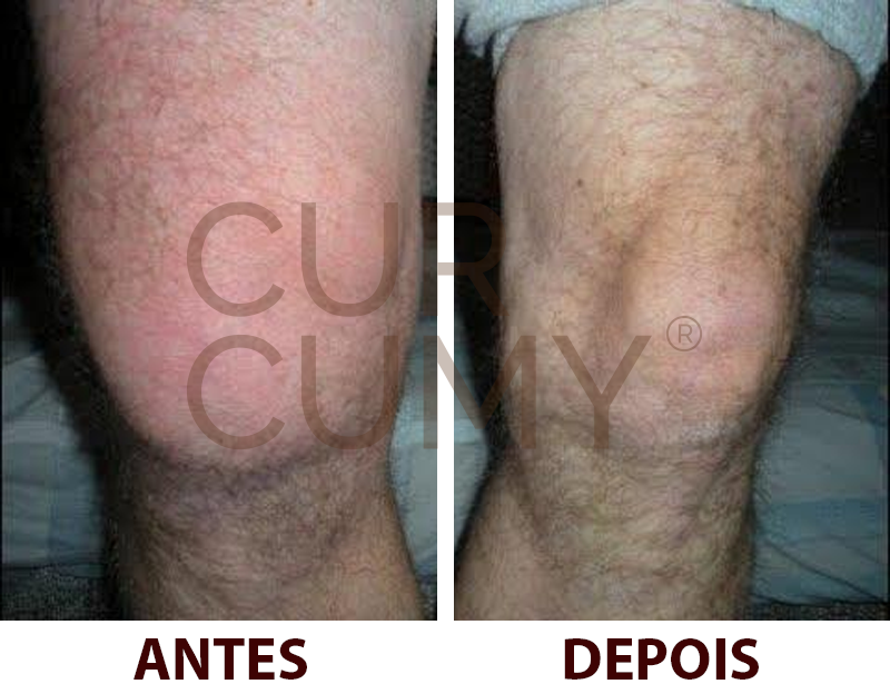 Curcumy 1 mês de tratamento