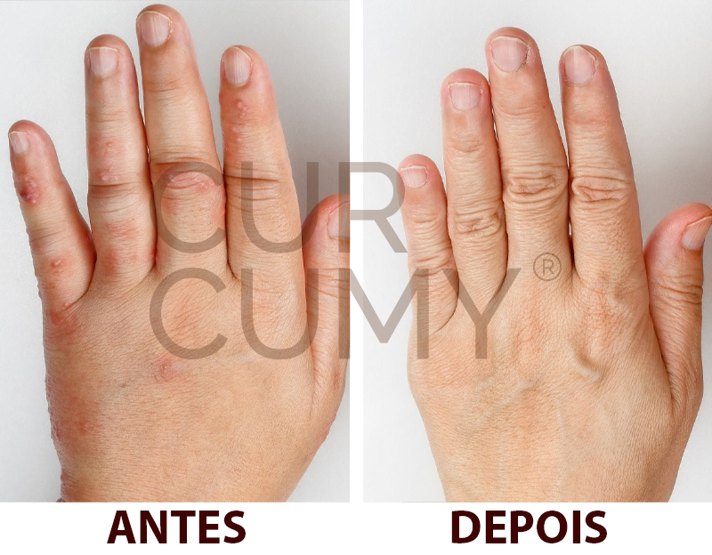 Curcumy 1 mês de tratamento
