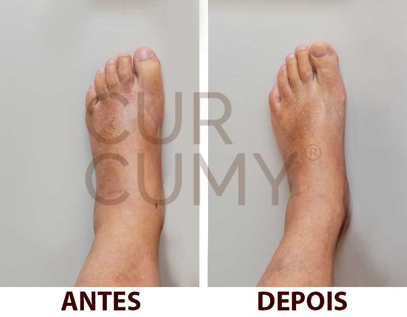 Curcumy 1 mês de tratamento