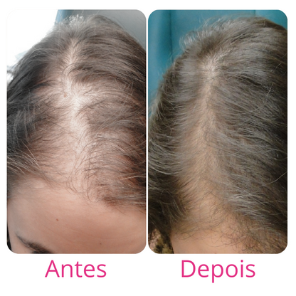 Harmony Hair Tratamento de 1 mês