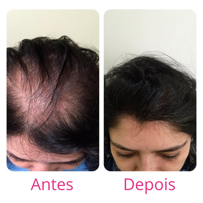 Harmony Hair Tratamento de 1 mês