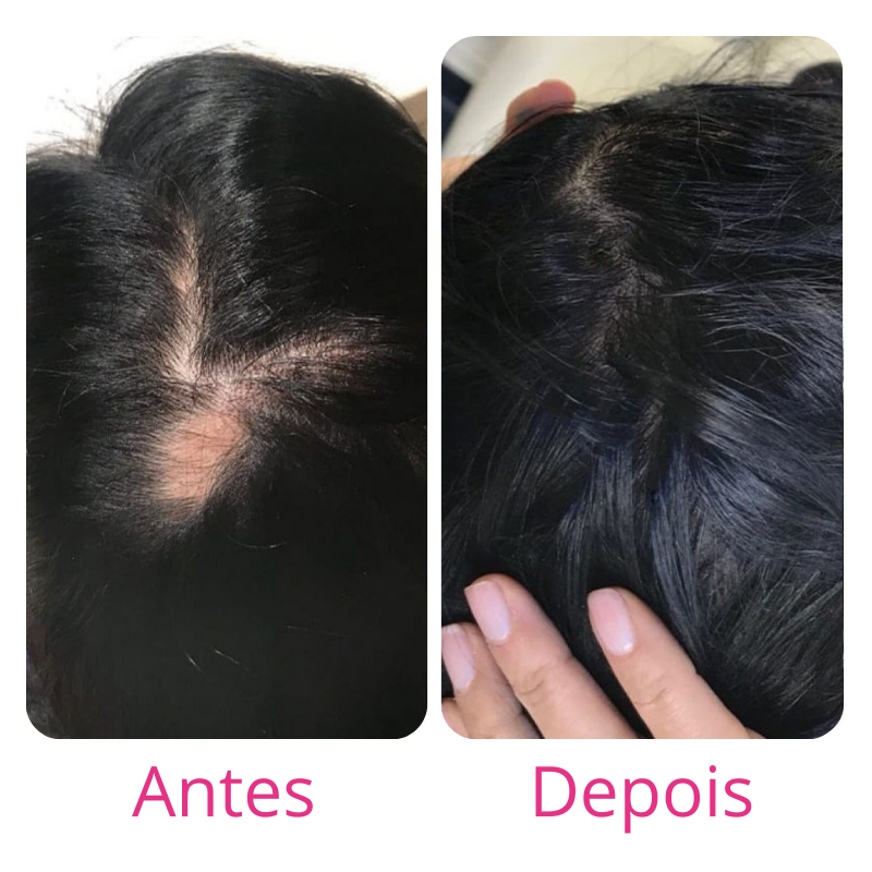 Harmony Hair Tratamento de 1 mês