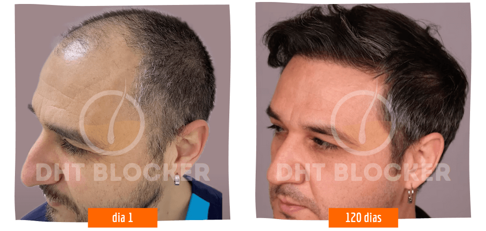DHT-BLOCKER 5 FLASCHEN