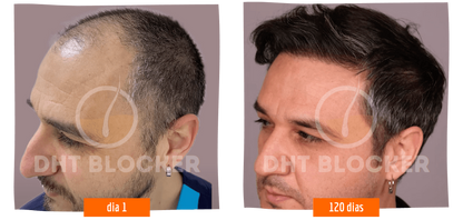 DHT-BLOCKER 5 FLASCHEN