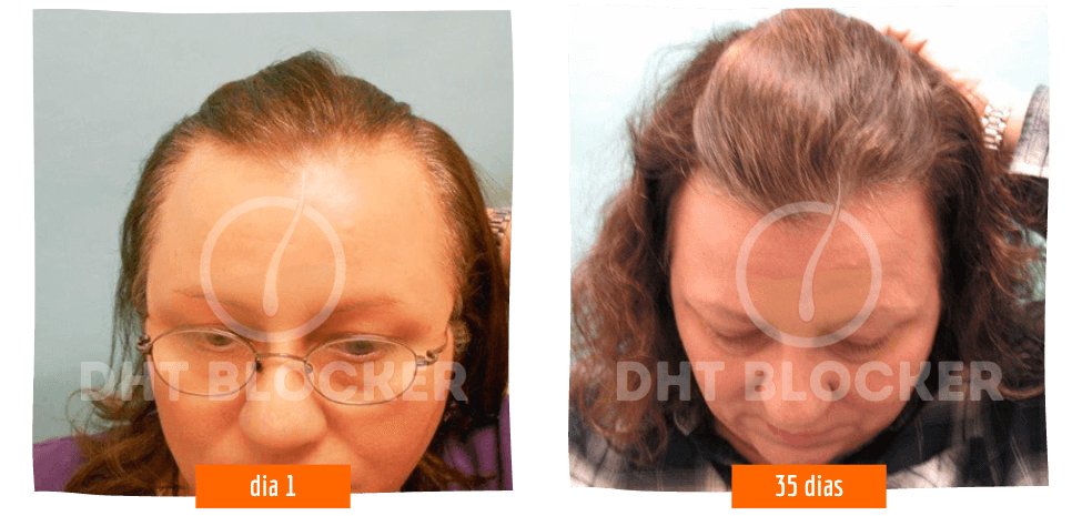 DHT-BLOCKER 5 FLASCHEN