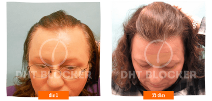 DHT-BLOCKER 5 FLASCHEN