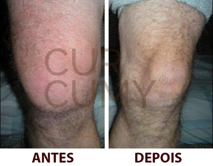 Curcumy 1 mês de tratamento