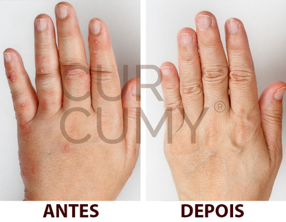 Curcumy 1 mês de tratamento